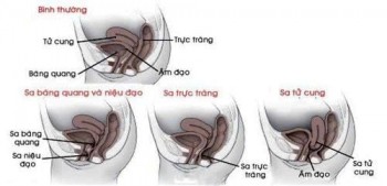SÓN TIỂU Ở PHỤ NỮ? NGUYÊN NHÂN, CHẨN ĐOÁN VÀ ĐIỀU TRỊ